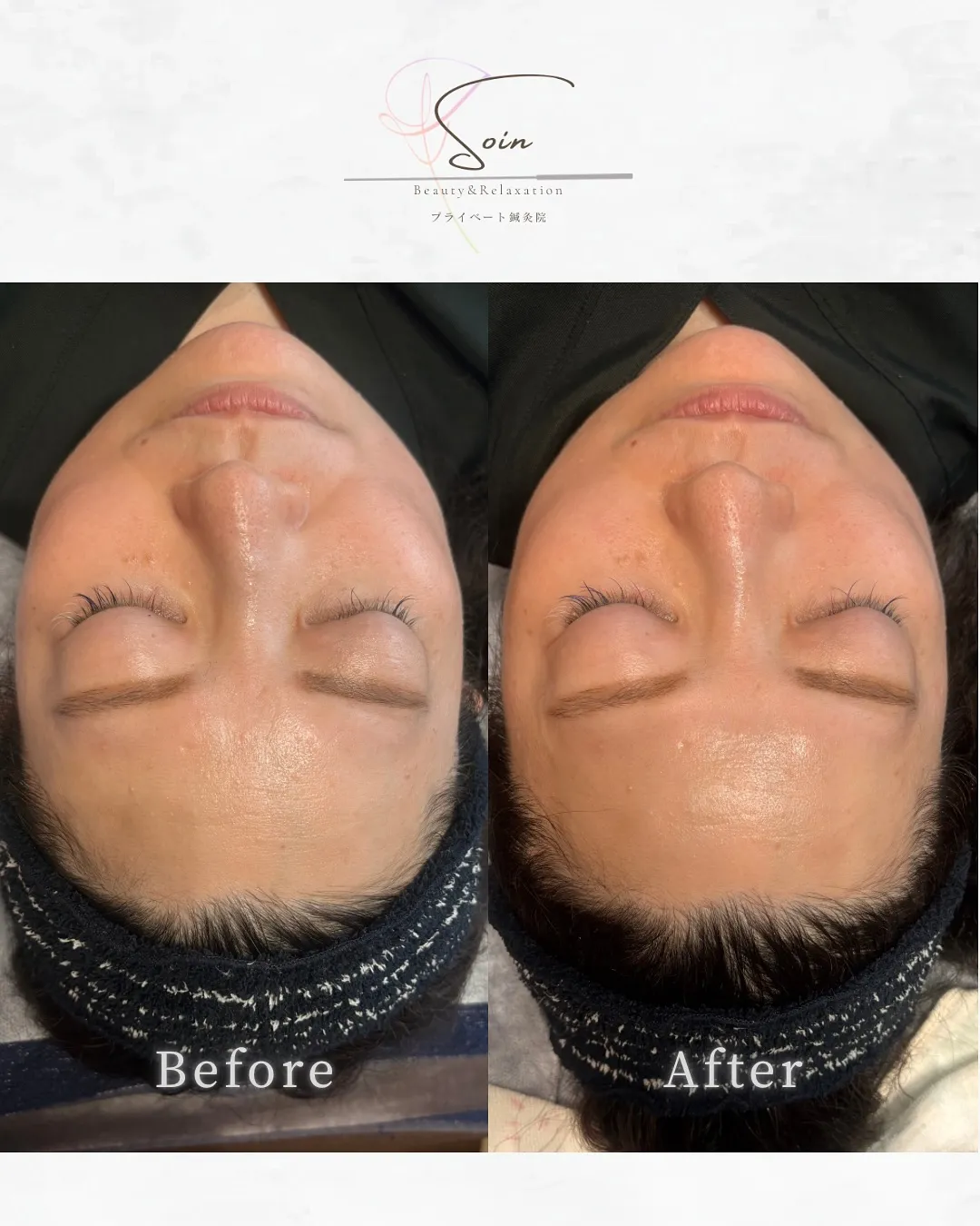 《 美容鍼 Before / After 》